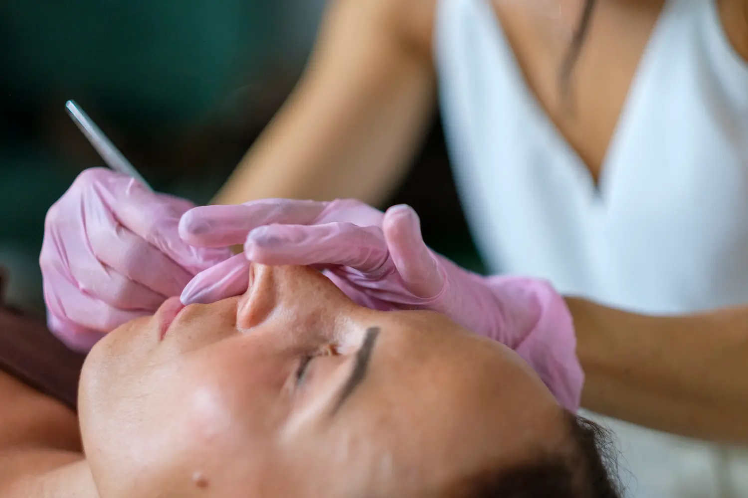 Trattamento di Microneedling Viso con Phi Academy da Glamour Estetica